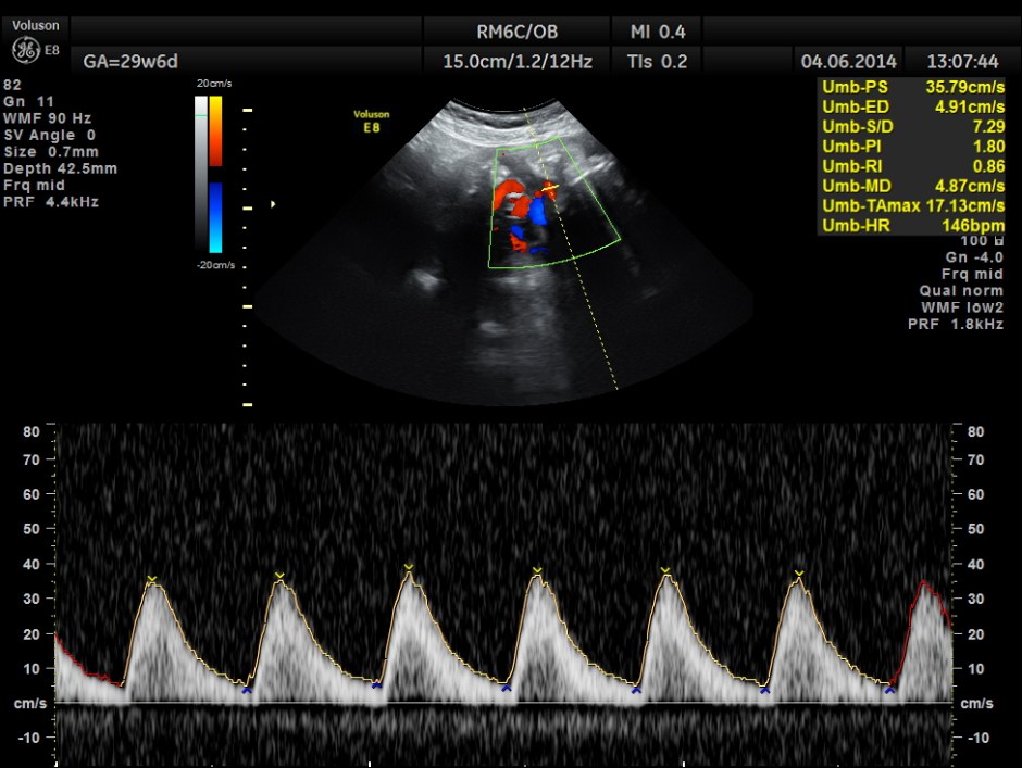 OBS IUGR ABN DOPPLER _10