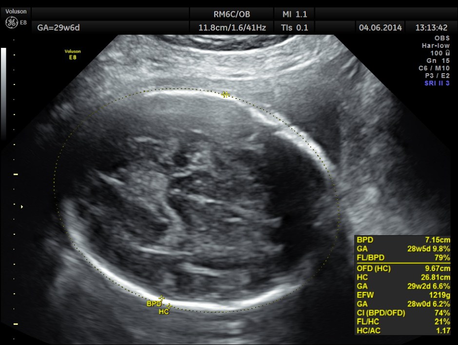 OBS IUGR ABN DOPPLER _14