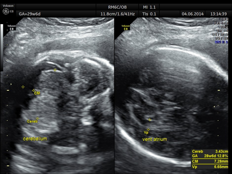 OBS IUGR ABN DOPPLER _16
