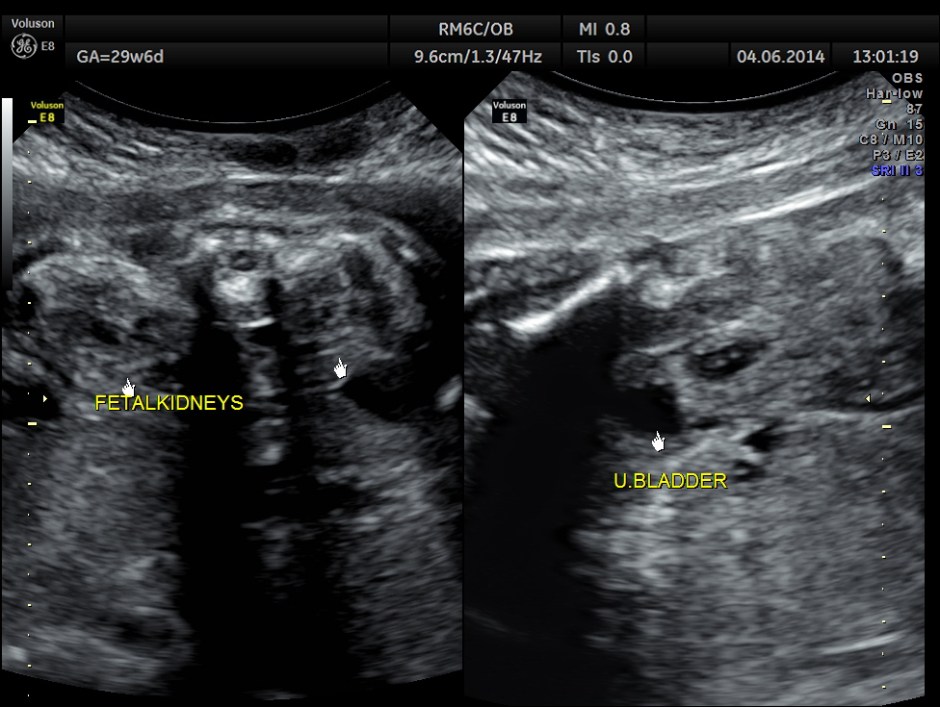 OBS IUGR ABN DOPPLER _4