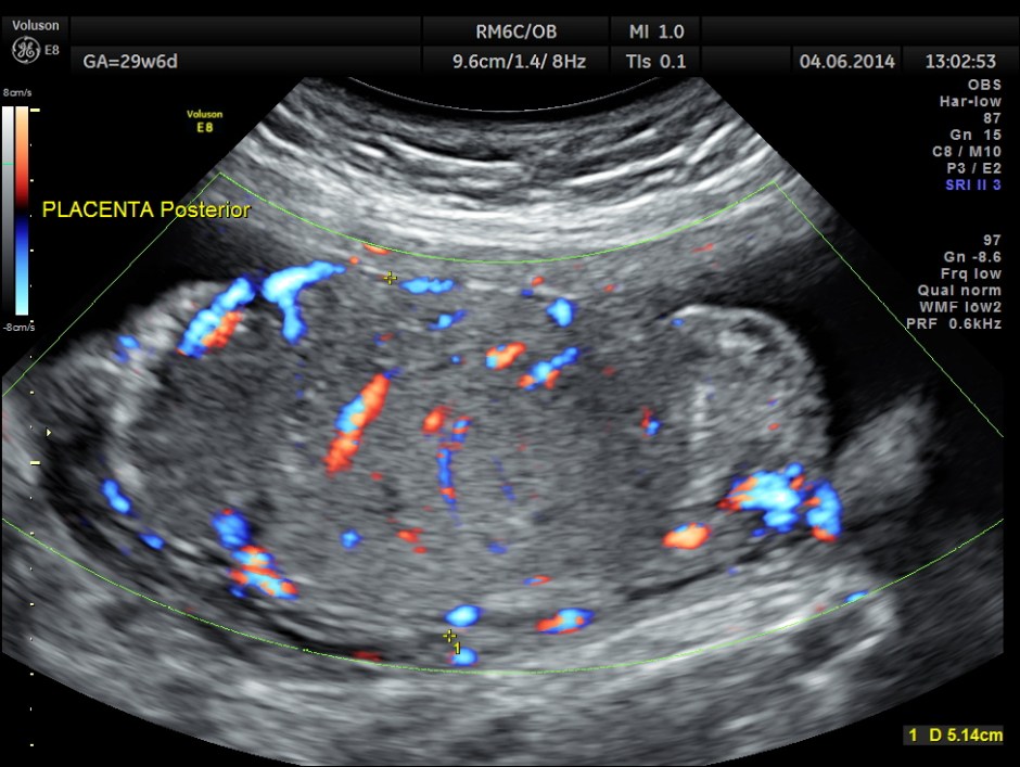 OBS IUGR ABN DOPPLER _5