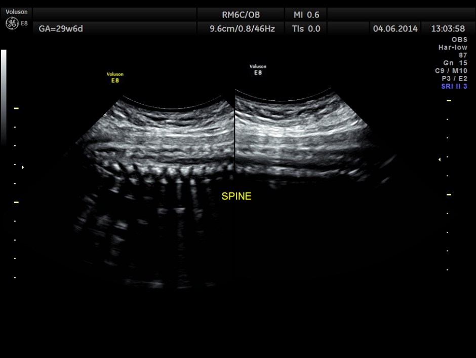 OBS IUGR ABN DOPPLER _6