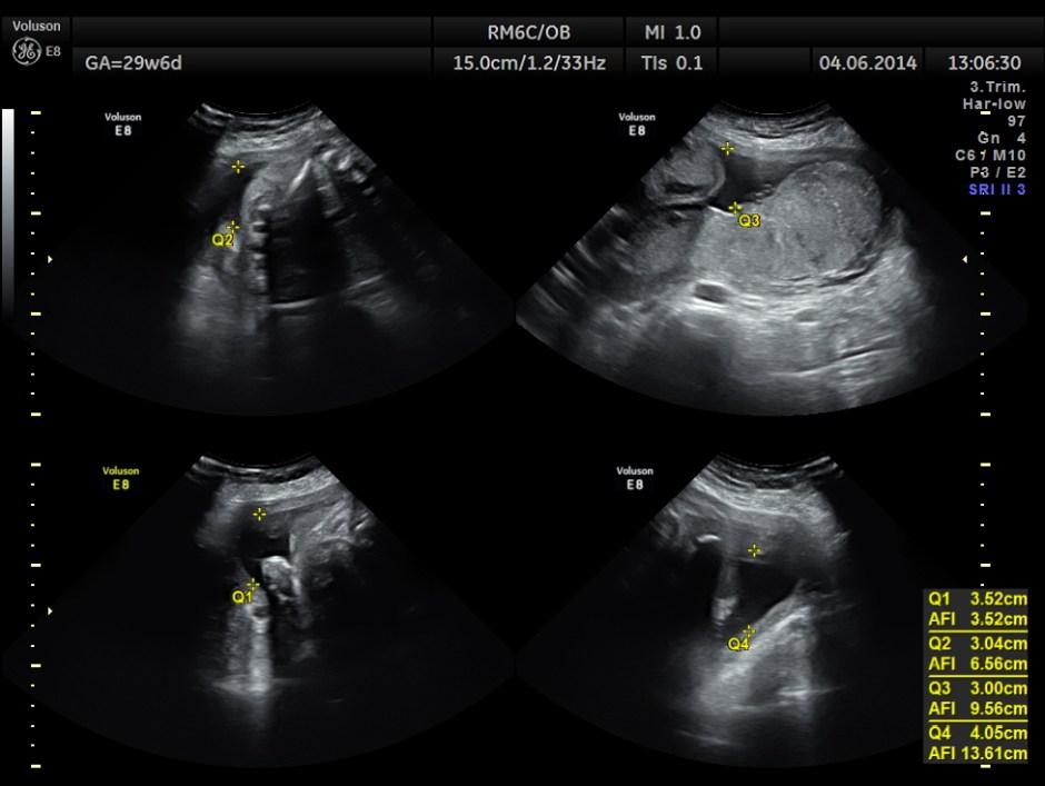 OBS IUGR ABN DOPPLER _9