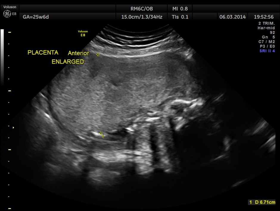 PLACENTOMEGALY DD SKE DYS IUGR _1
