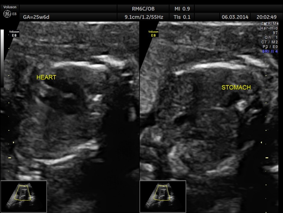 PLACENTOMEGALY DD SKE DYS IUGR _12