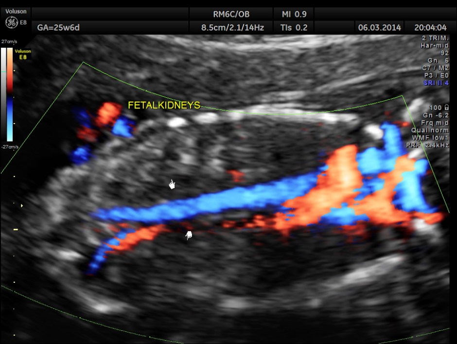 PLACENTOMEGALY DD SKE DYS IUGR _13
