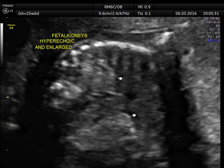 PLACENTOMEGALY DD SKE DYS IUGR _15