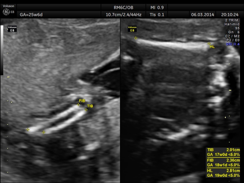 PLACENTOMEGALY DD SKE DYS IUGR _16