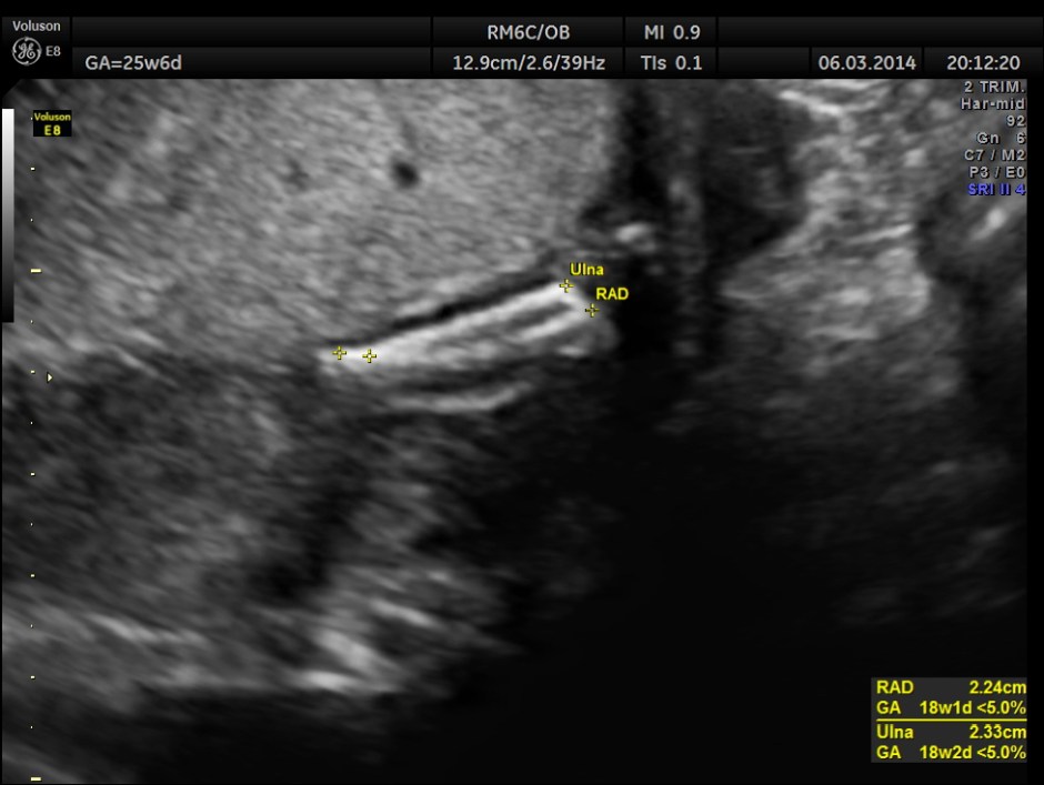PLACENTOMEGALY DD SKE DYS IUGR _17