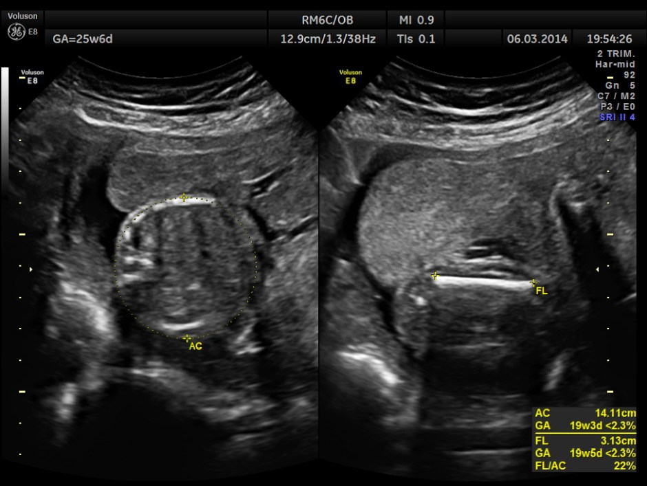 PLACENTOMEGALY DD SKE DYS IUGR _2