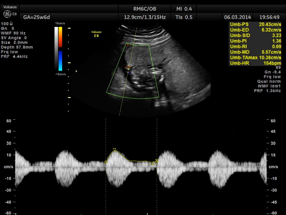 PLACENTOMEGALY DD SKE DYS IUGR _4