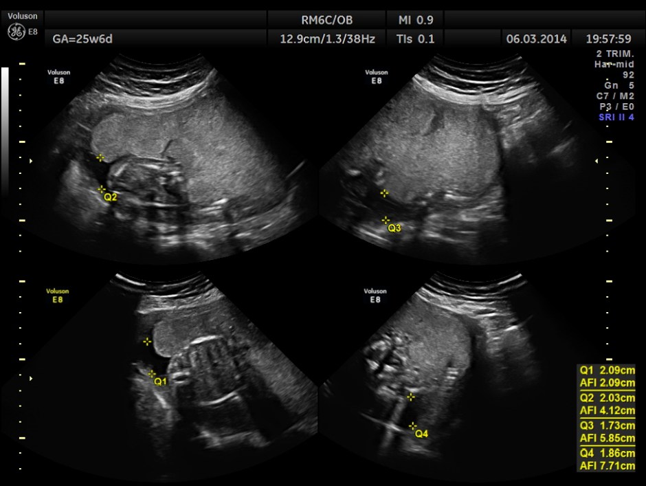 PLACENTOMEGALY DD SKE DYS IUGR _6