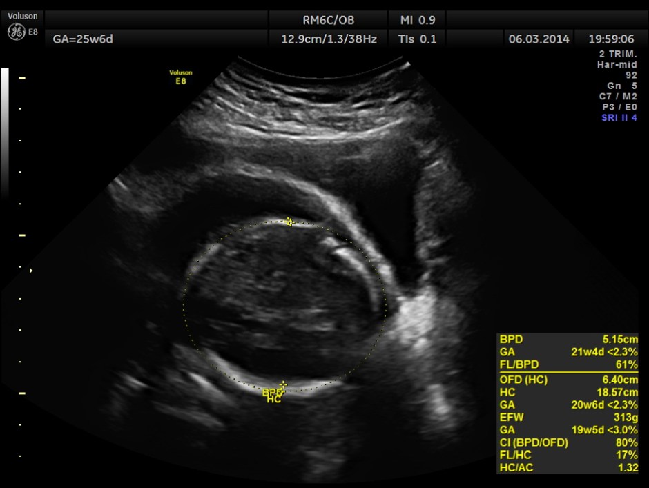 PLACENTOMEGALY DD SKE DYS IUGR _7