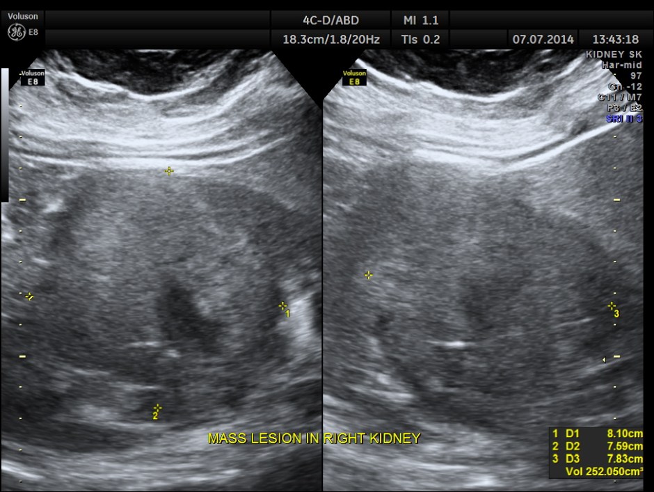 KIDNEY  HYPERNEPHROMA_10