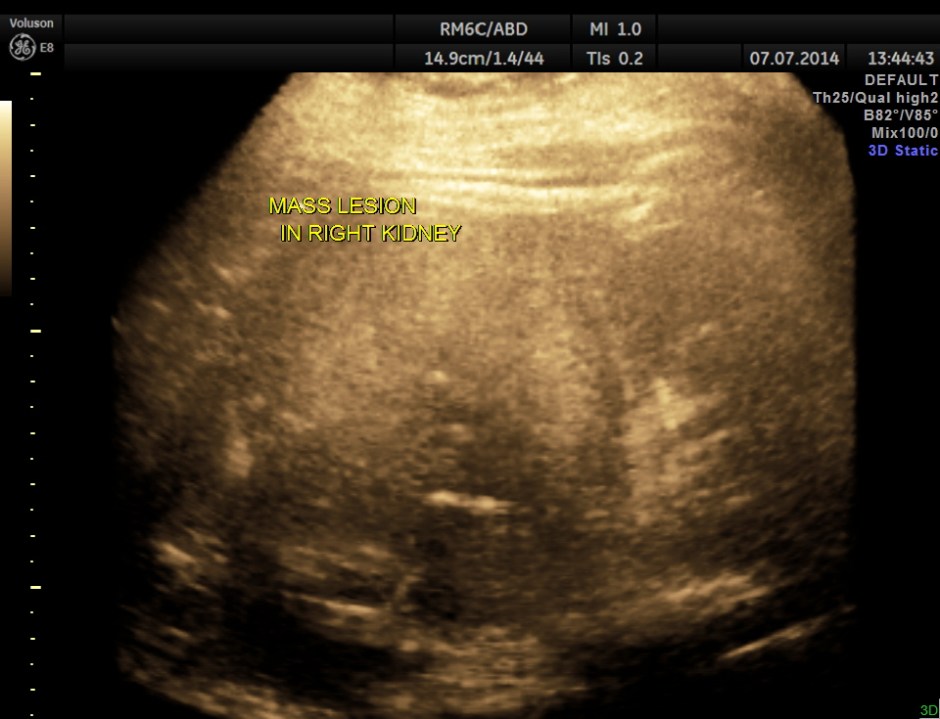 KIDNEY  HYPERNEPHROMA_11