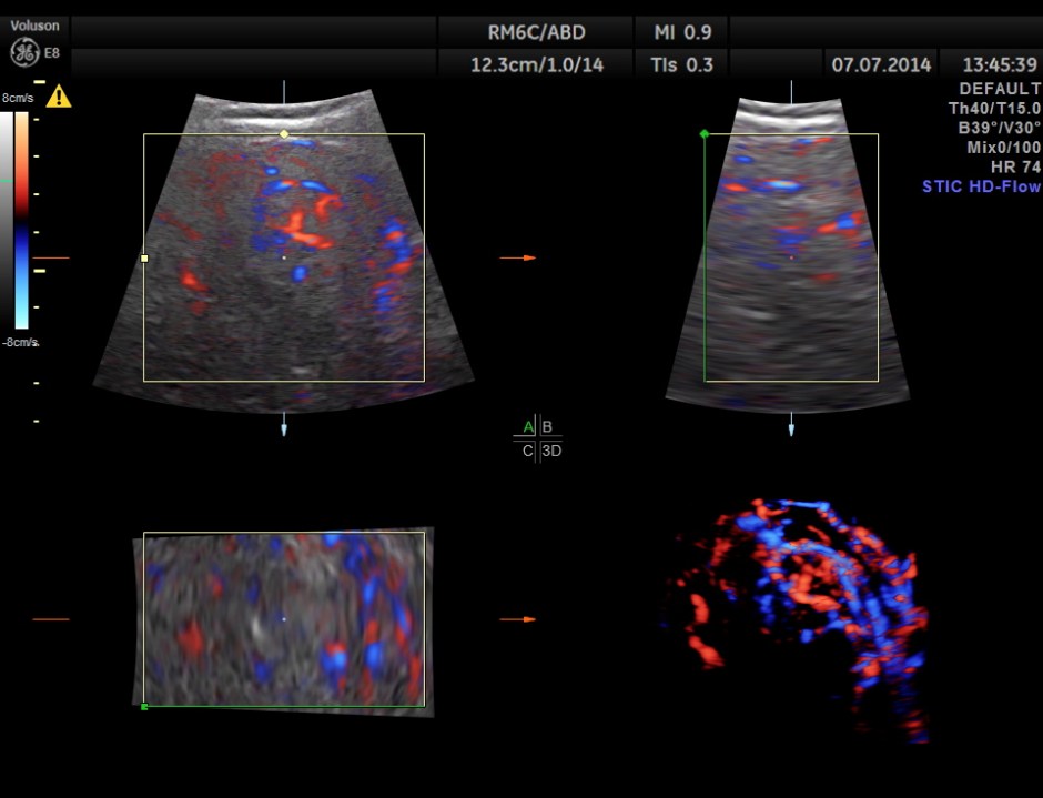KIDNEY  HYPERNEPHROMA_12