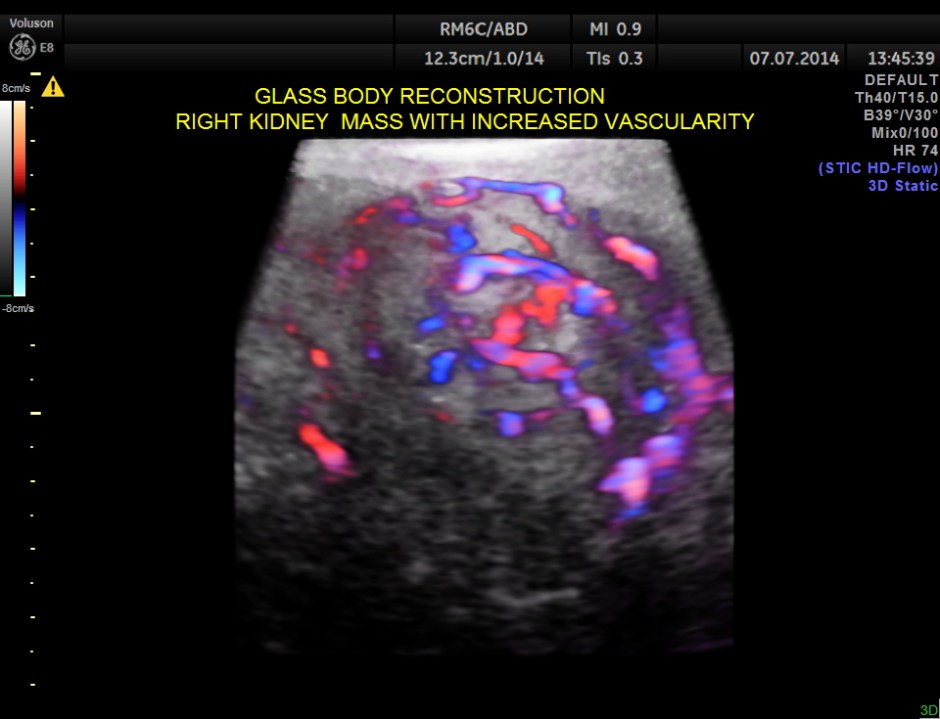 KIDNEY  HYPERNEPHROMA_14