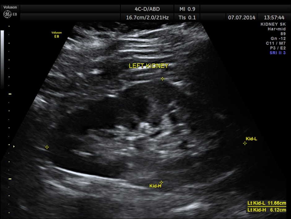 KIDNEY  HYPERNEPHROMA_18