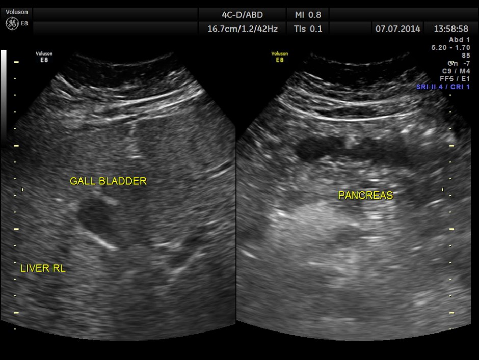 KIDNEY  HYPERNEPHROMA_19
