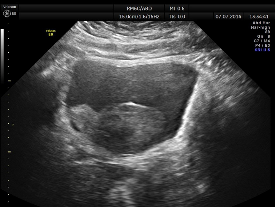 KIDNEY  HYPERNEPHROMA_2