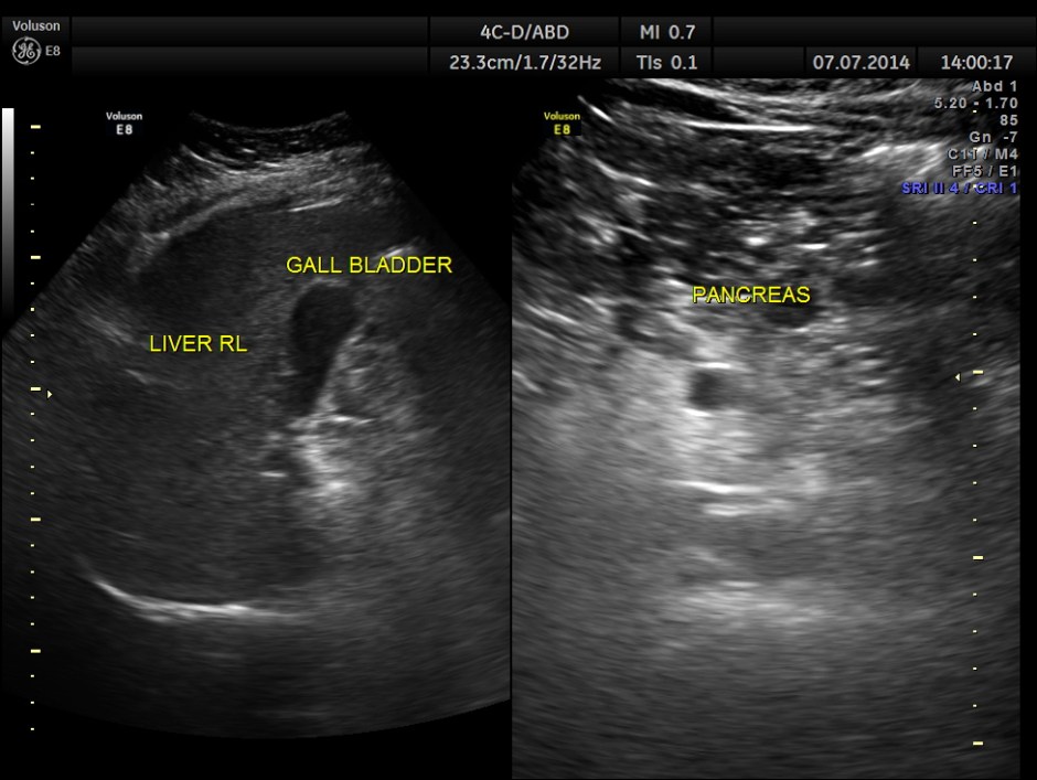 KIDNEY  HYPERNEPHROMA_20