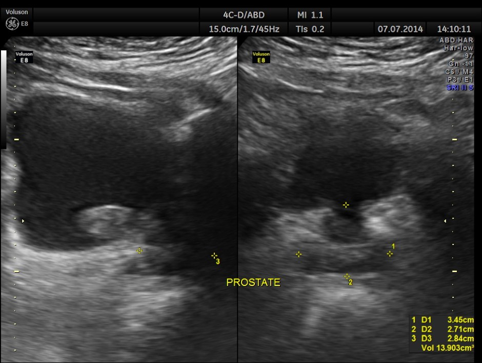 KIDNEY  HYPERNEPHROMA_21