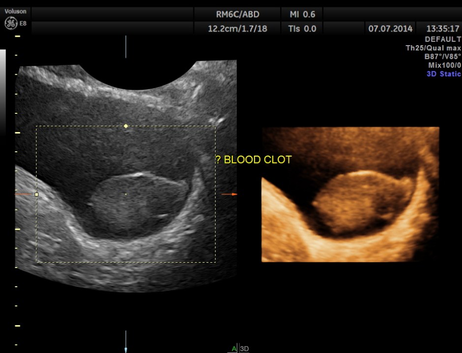 KIDNEY  HYPERNEPHROMA_3
