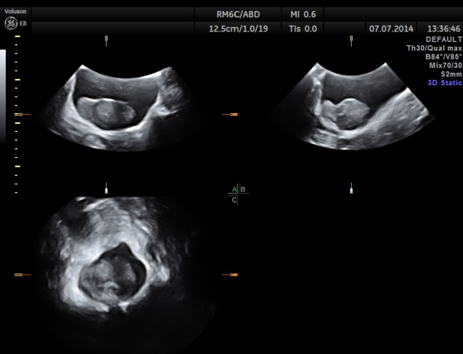 KIDNEY  HYPERNEPHROMA_4