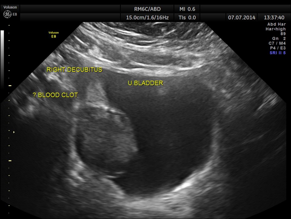 KIDNEY  HYPERNEPHROMA_5