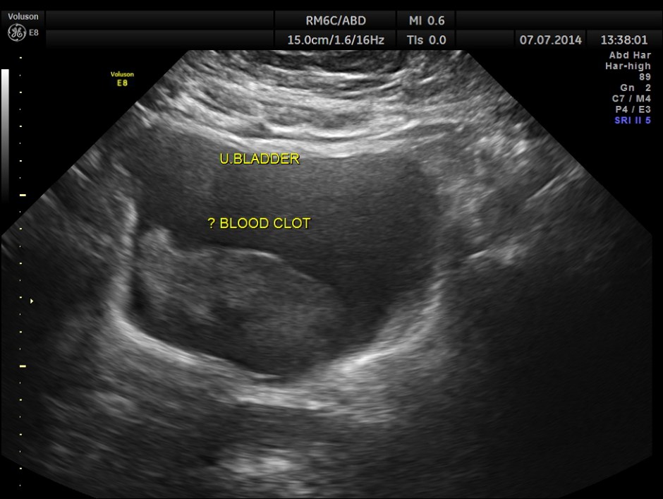 KIDNEY  HYPERNEPHROMA_6