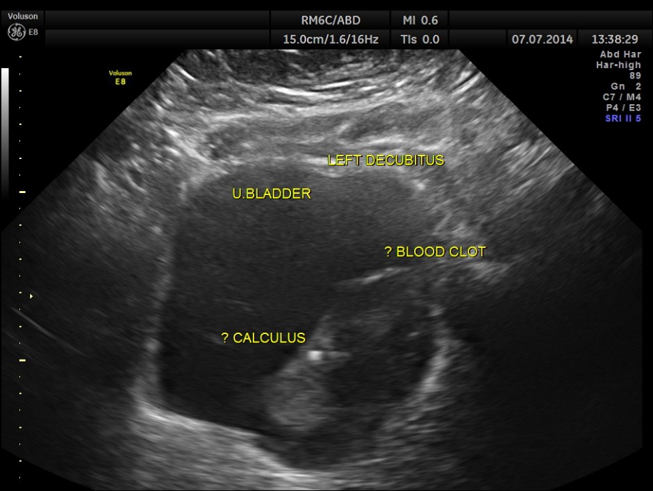 KIDNEY  HYPERNEPHROMA_7