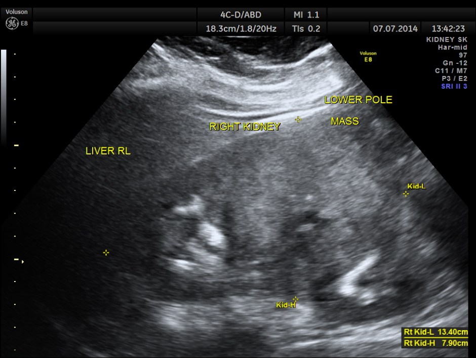 KIDNEY  HYPERNEPHROMA_8