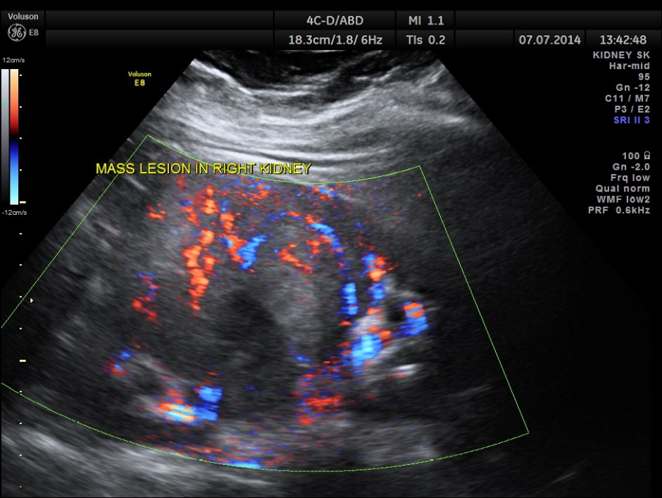 KIDNEY  HYPERNEPHROMA_9