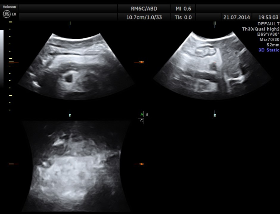 ABD CHR PANCREATITIS _10