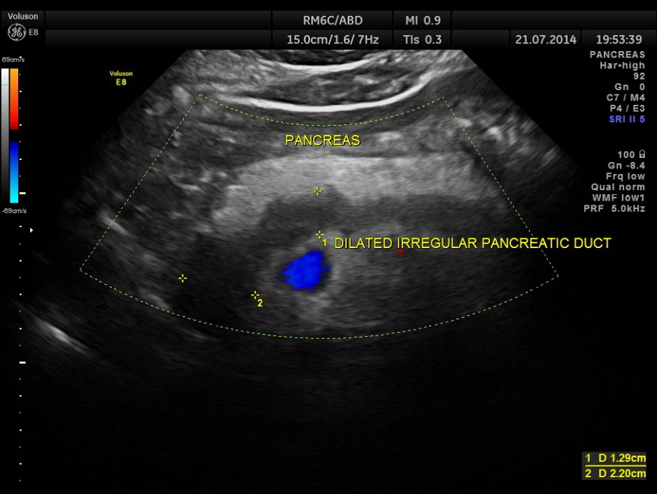 ABD CHR PANCREATITIS _11