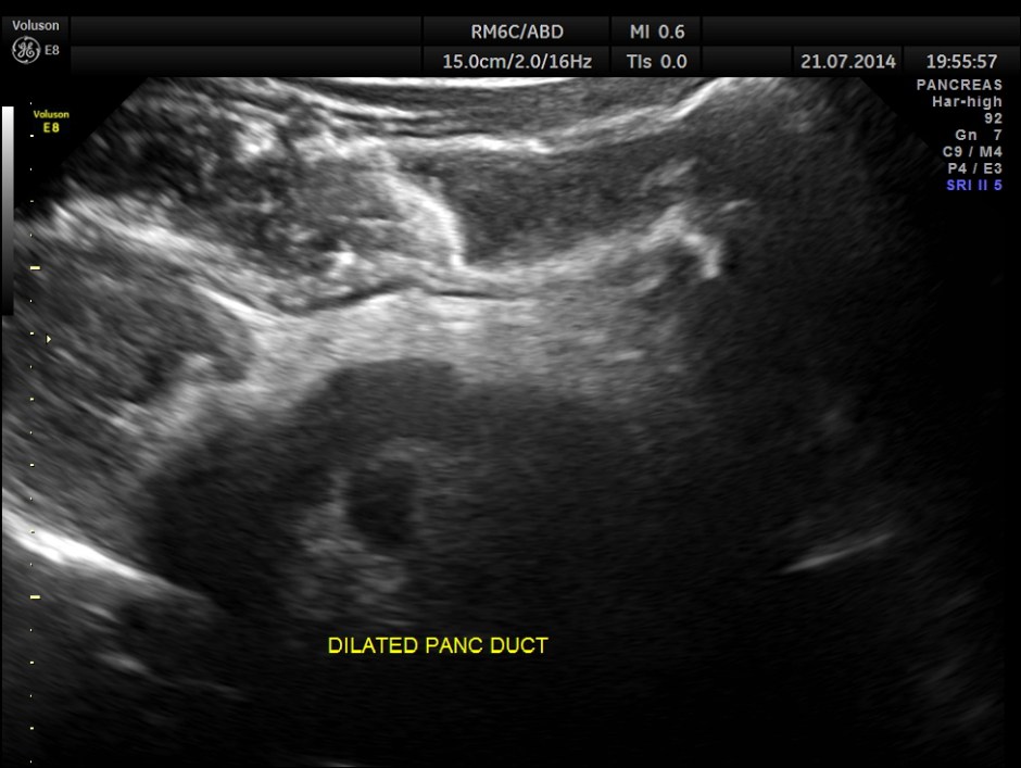 ABD CHR PANCREATITIS _12