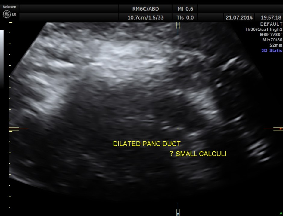 ABD CHR PANCREATITIS _13