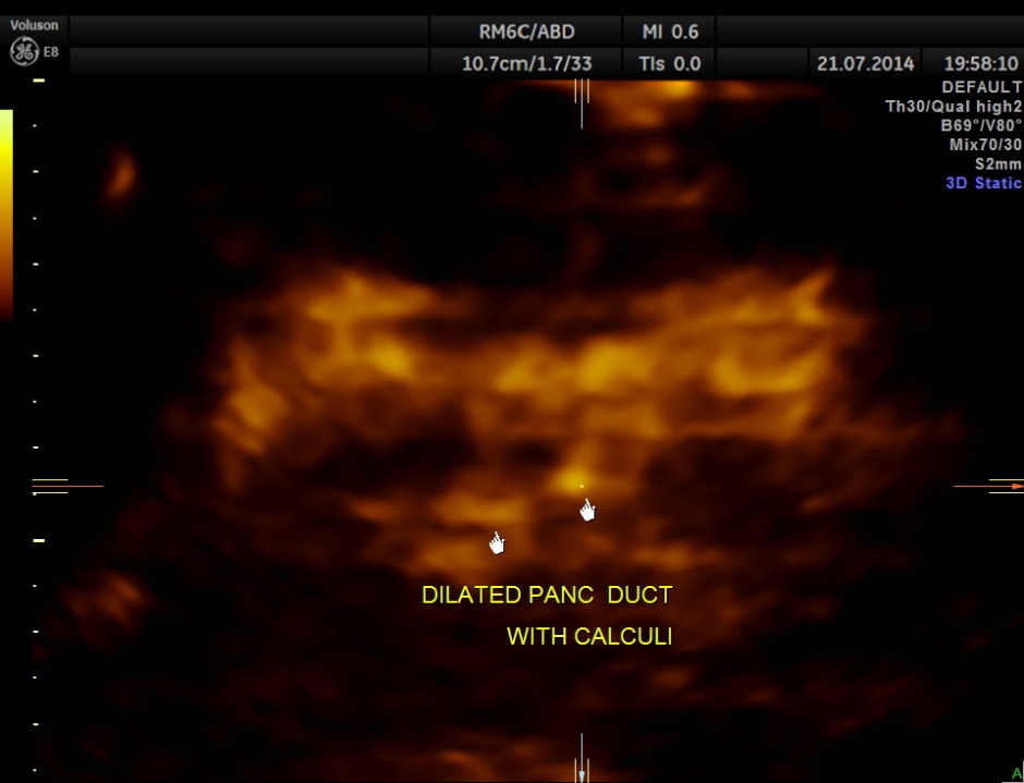 ABD CHR PANCREATITIS _14