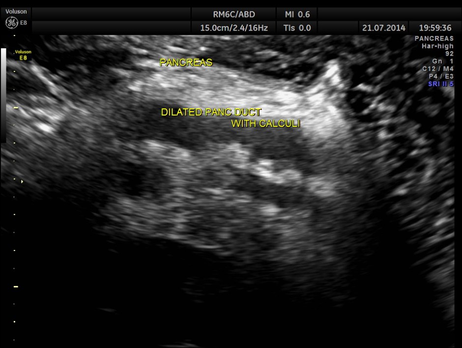 ABD CHR PANCREATITIS _15