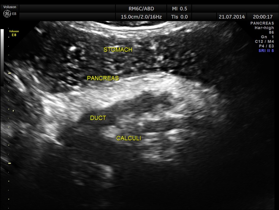 ABD CHR PANCREATITIS _16