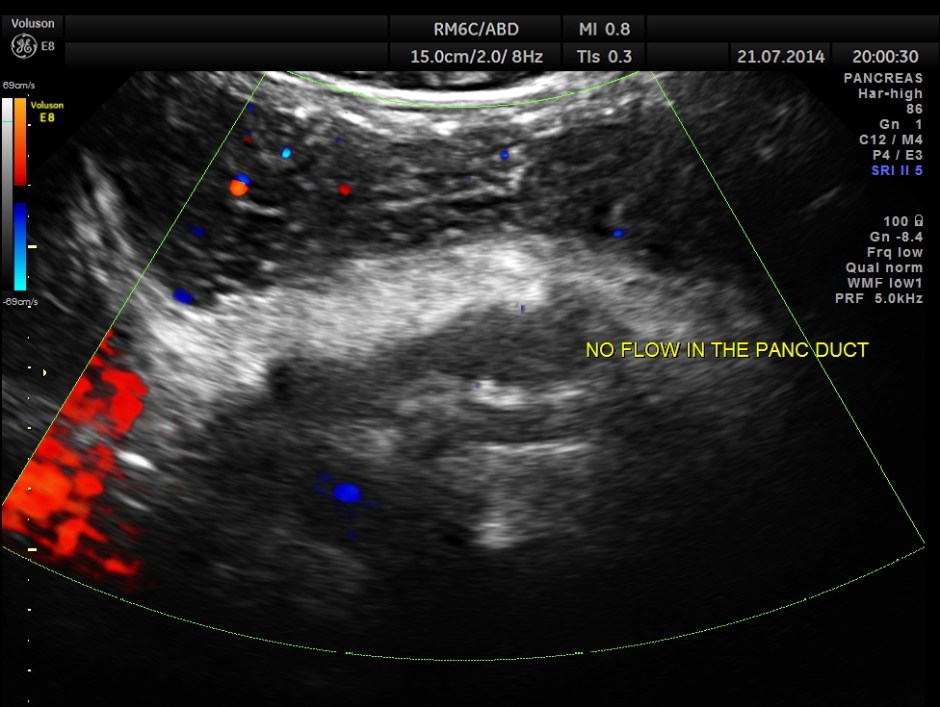 ABD CHR PANCREATITIS _17