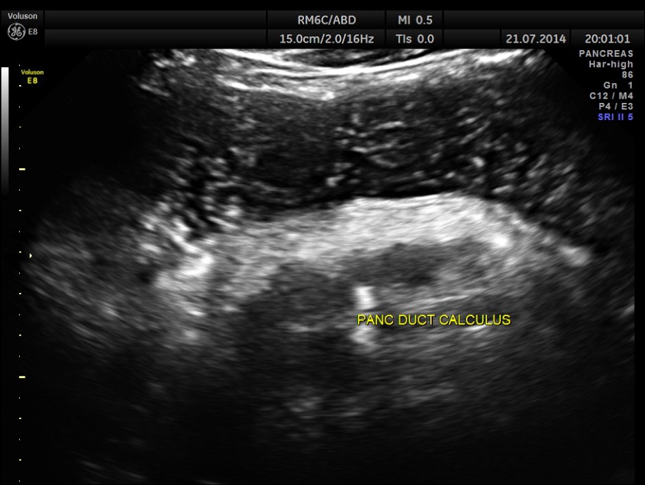 ABD CHR PANCREATITIS _18