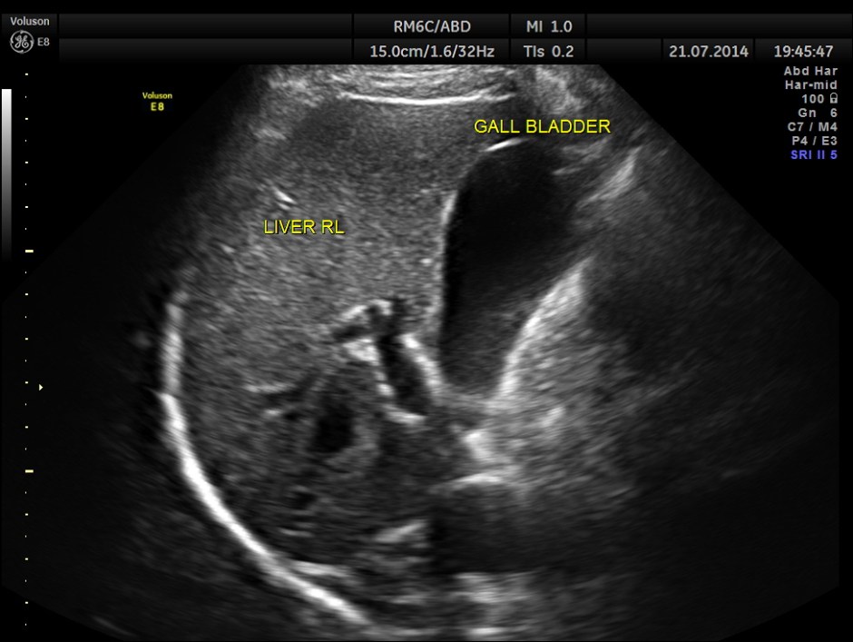 ABD CHR PANCREATITIS _2
