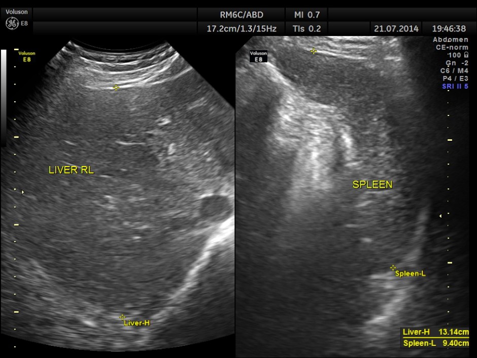ABD CHR PANCREATITIS _3