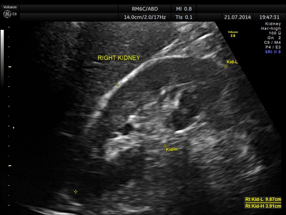 ABD CHR PANCREATITIS _4