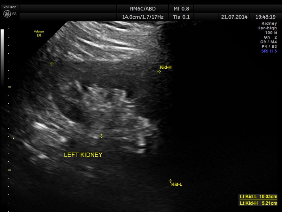 ABD CHR PANCREATITIS _5