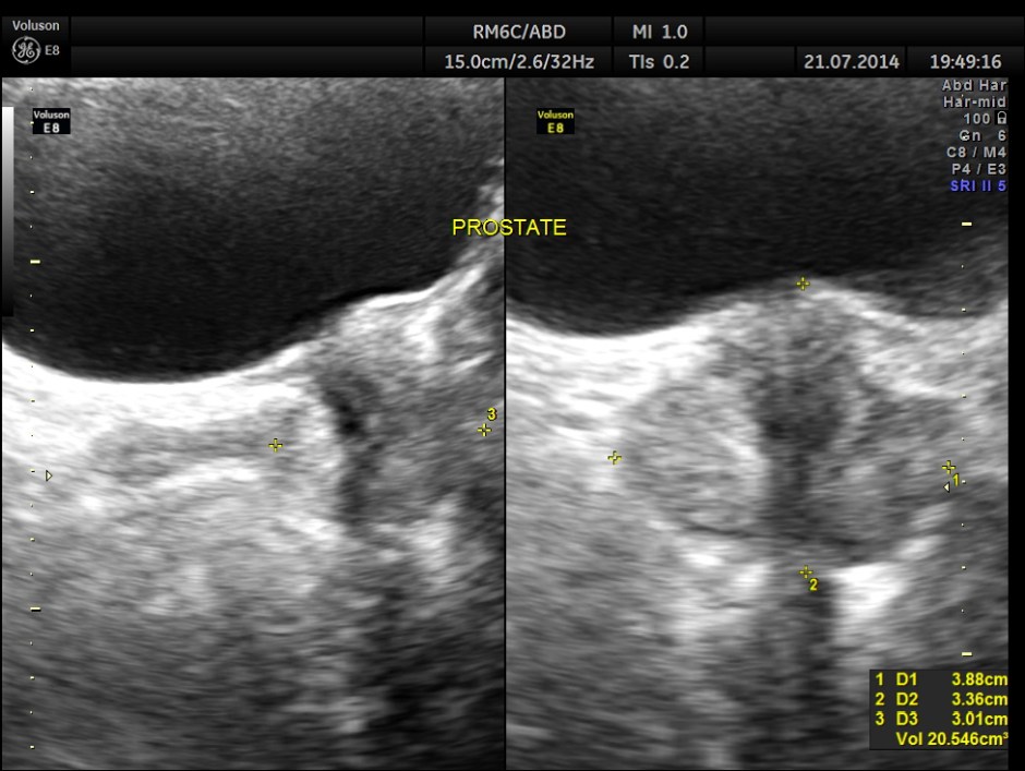 ABD CHR PANCREATITIS _6