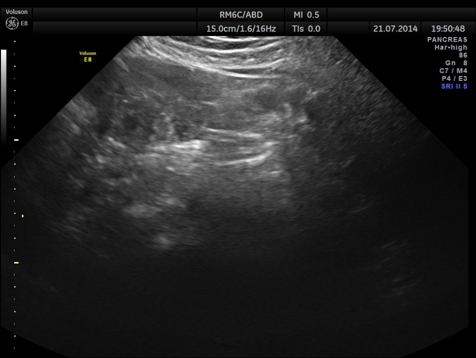 ABD CHR PANCREATITIS _7