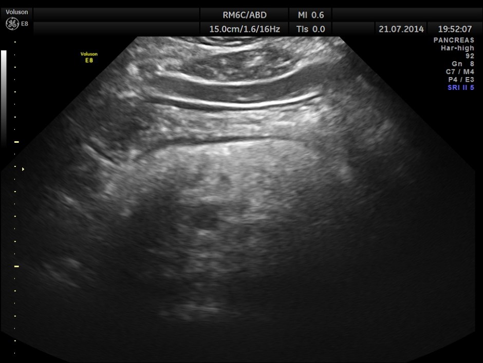 ABD CHR PANCREATITIS _8