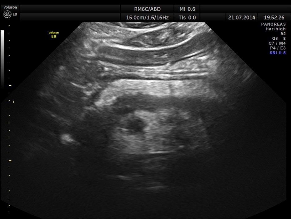 ABD CHR PANCREATITIS _9